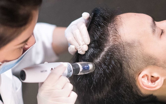 Mésothérapie capillaire (Traitement de la chute, perte hormonale, amincissement et faiblesse des cheveux)
